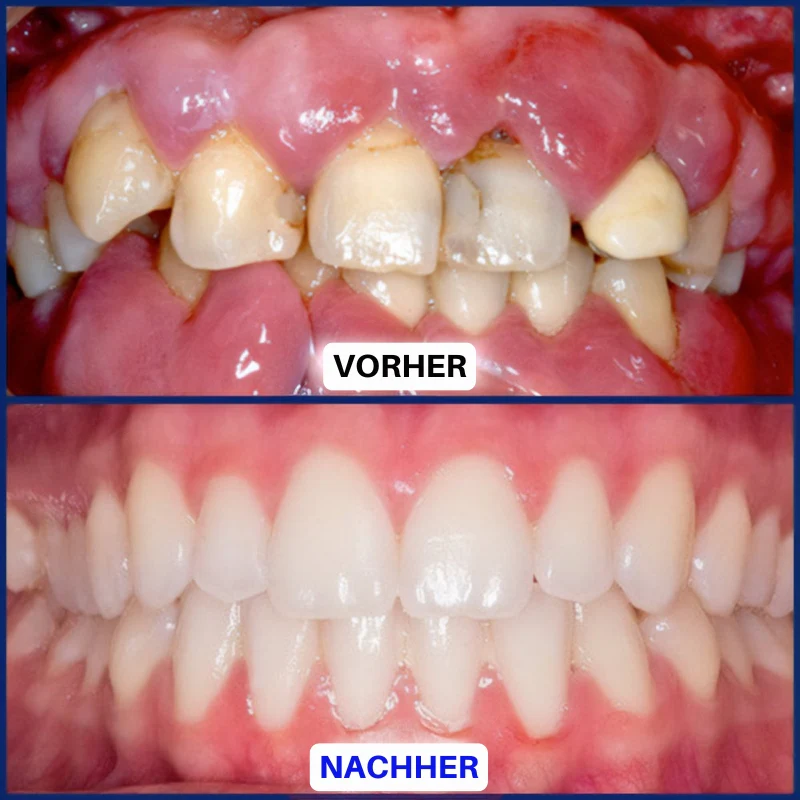 Balancia™ | Bienengift gegen Zahnfleischrückgang - Image 12