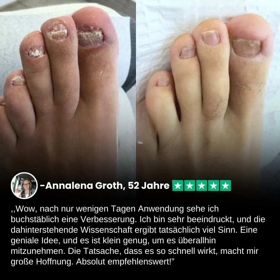 ClearNail Pro™ | Nagelpilz-Lasergerät - Image 3