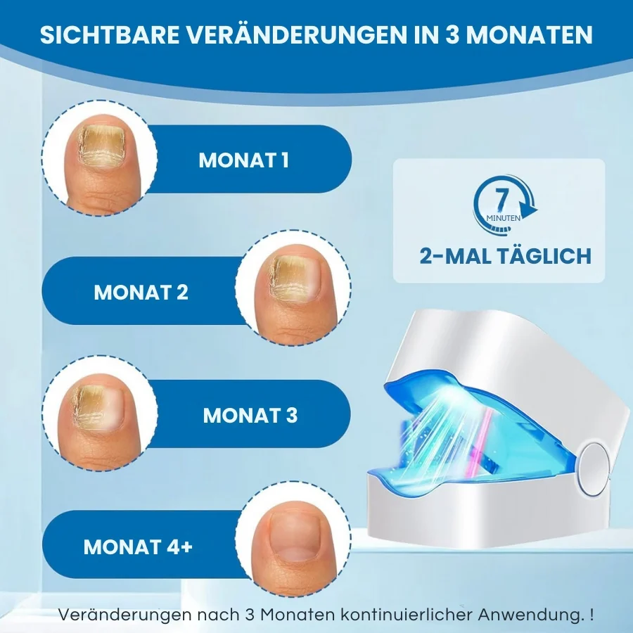 ClearNail Pro™ | Nagelpilz-Lasergerät - Image 4