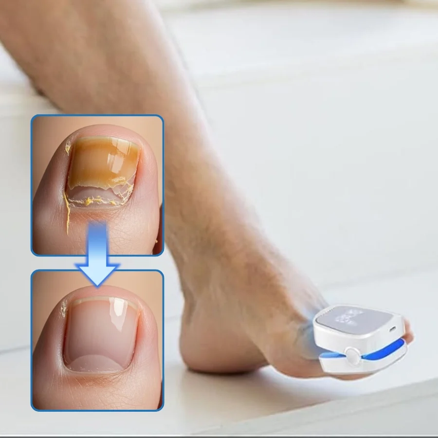 ClearNail Pro™ | Nagelpilz-Lasergerät - Image 9