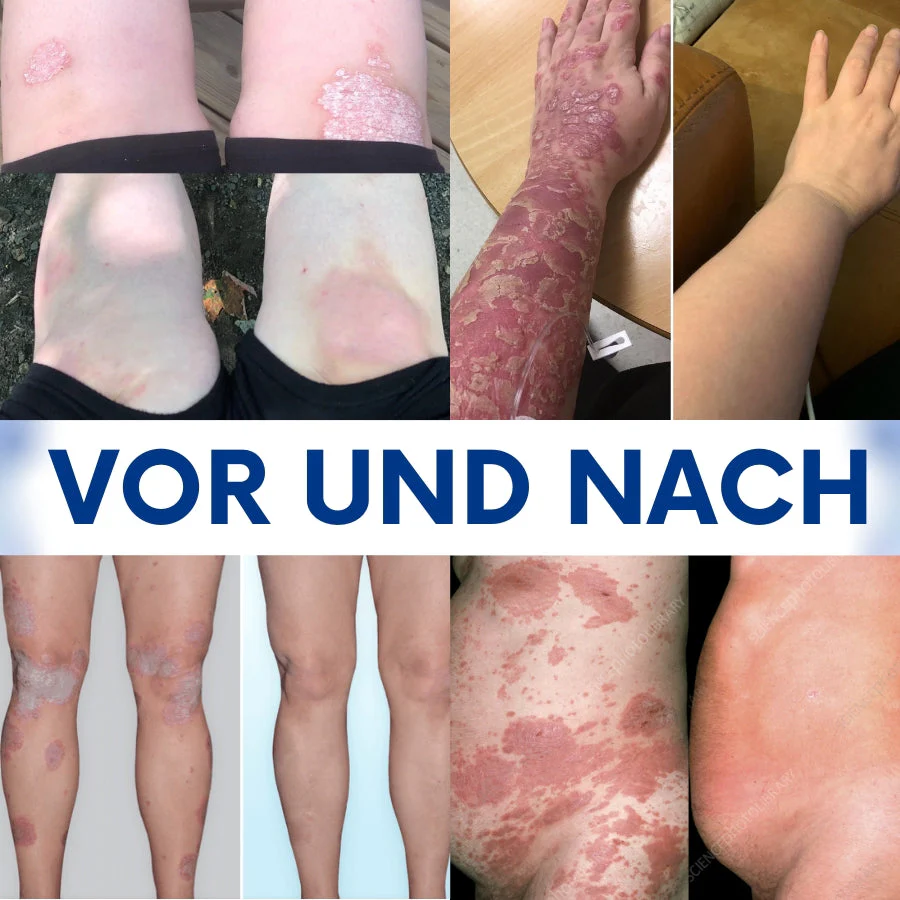 CuraSkin™ | Psoriasis- und Ekzem-Creme - Image 10