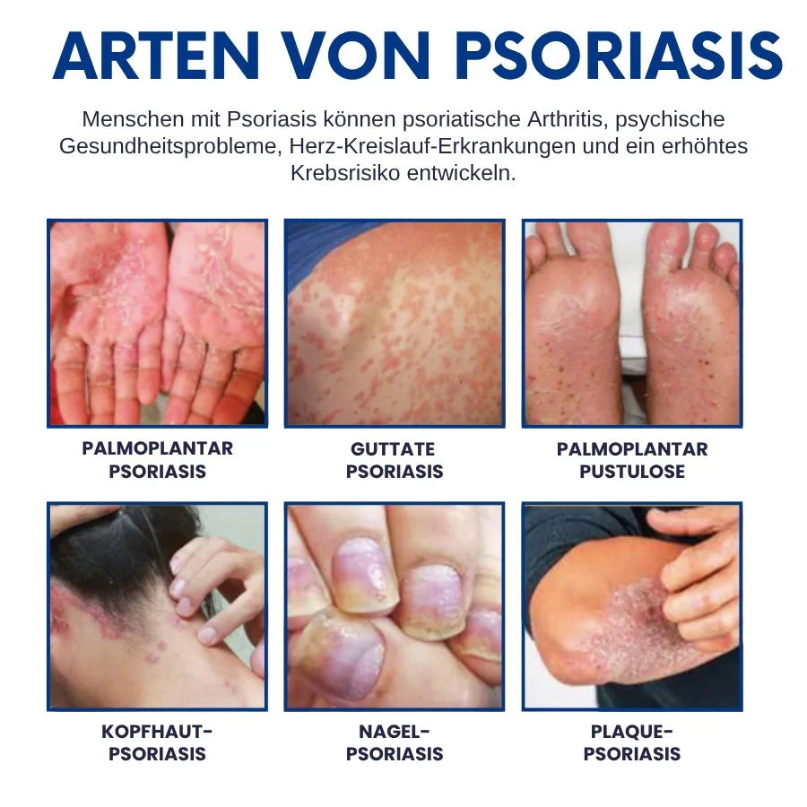 CuraSkin™ | Psoriasis- und Ekzem-Creme - Image 2