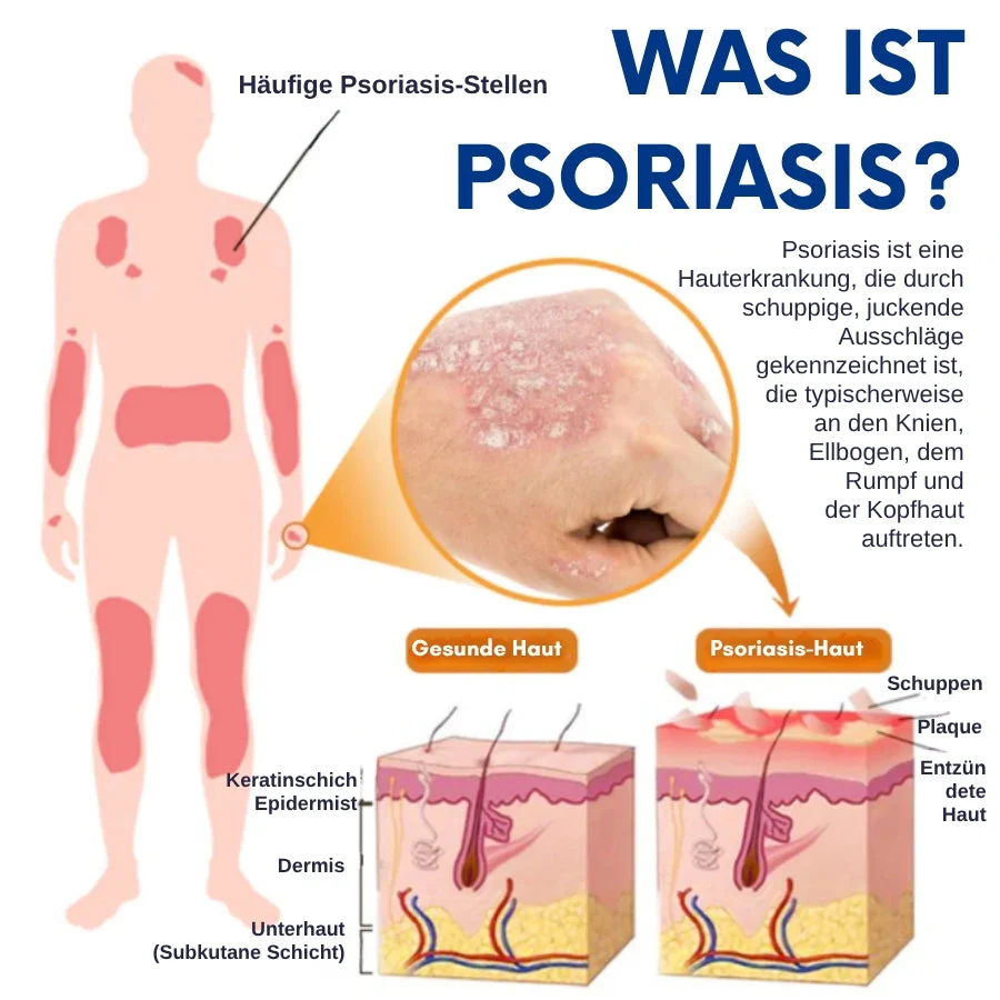 CuraSkin™ | Psoriasis- und Ekzem-Creme - Image 4
