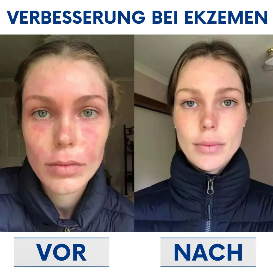 CuraSkin™ | Psoriasis- und Ekzem-Creme - Image 7