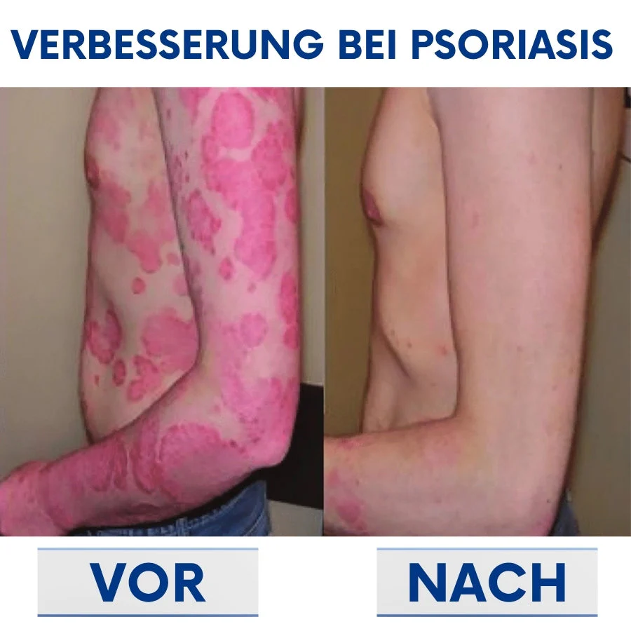 CuraSkin™ | Psoriasis- und Ekzem-Creme - Image 8