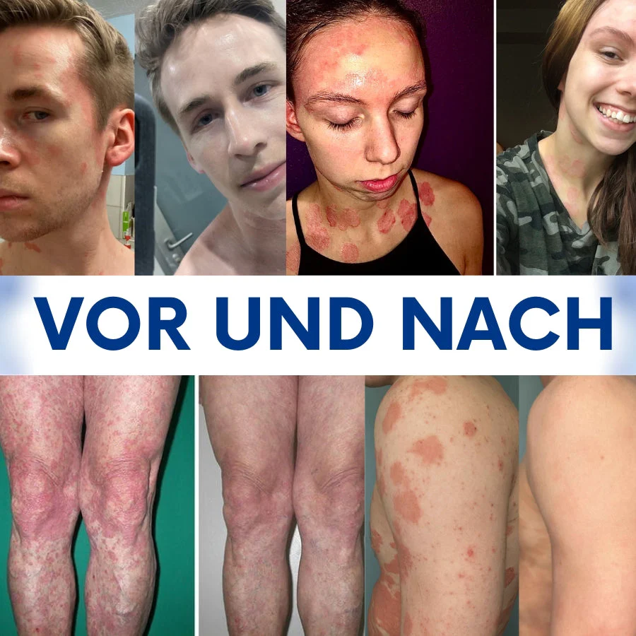CuraSkin™ | Psoriasis- und Ekzem-Creme - Image 9