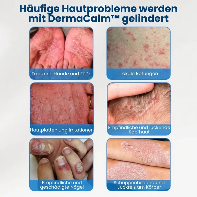 DermaCalm™ | Natürliche Linderung bei juckender Kopfhaut oder Haut - Image 6