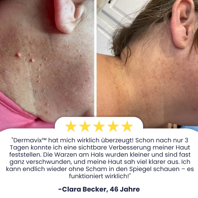 Dermavix™ | Entfernt 97% der Warzen & Hauttaggen in nur 3 Tagen! - Image 3