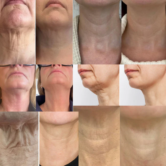 FirmNeck™ | Straffe und hebe deinen Hals in nur 7 Tagen! - Image 4