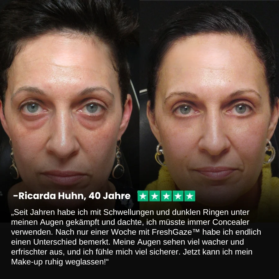 FreshGaze™ Augenbalsam | Verabschiede dich von Schwellungen und feinen Linien um 97% in 24 Stunden! - Image 8