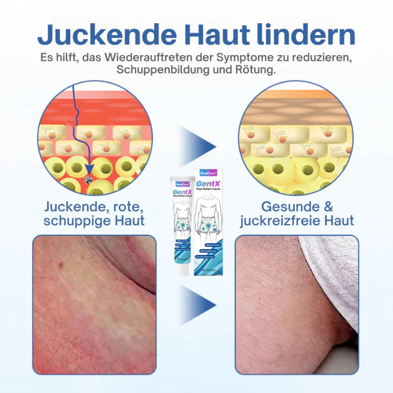 GentCare™ | Creme zur Linderung von Genitalwarzen - Image 9