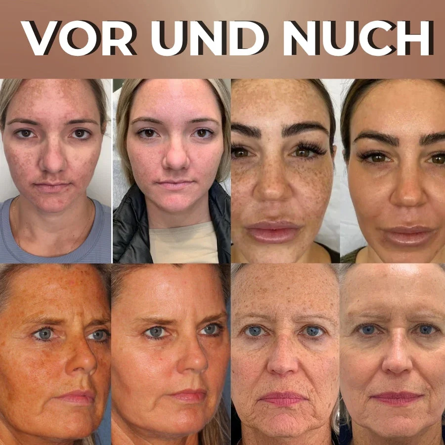 GlowPeel™ | Peeling-Gesichtsmaske - Image 4