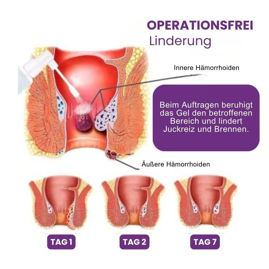 HemoCure™ | Hämorrhoiden Erfrischendes Beruhigendes Gel - Image 6
