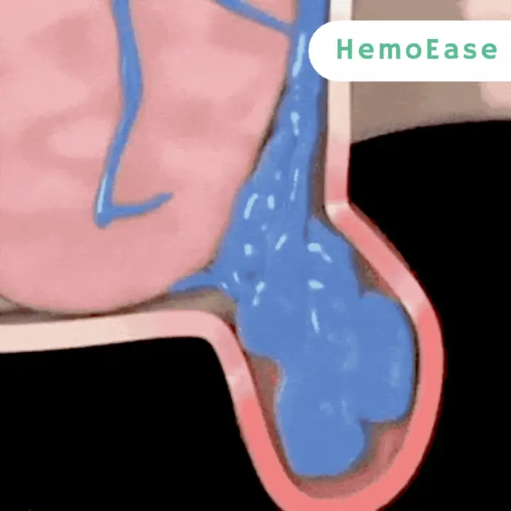 HemoEase™ Creme | Lindert 99 % der Hämorrhoidenschmerzen bereits bei der ersten Anwendung - Image 4