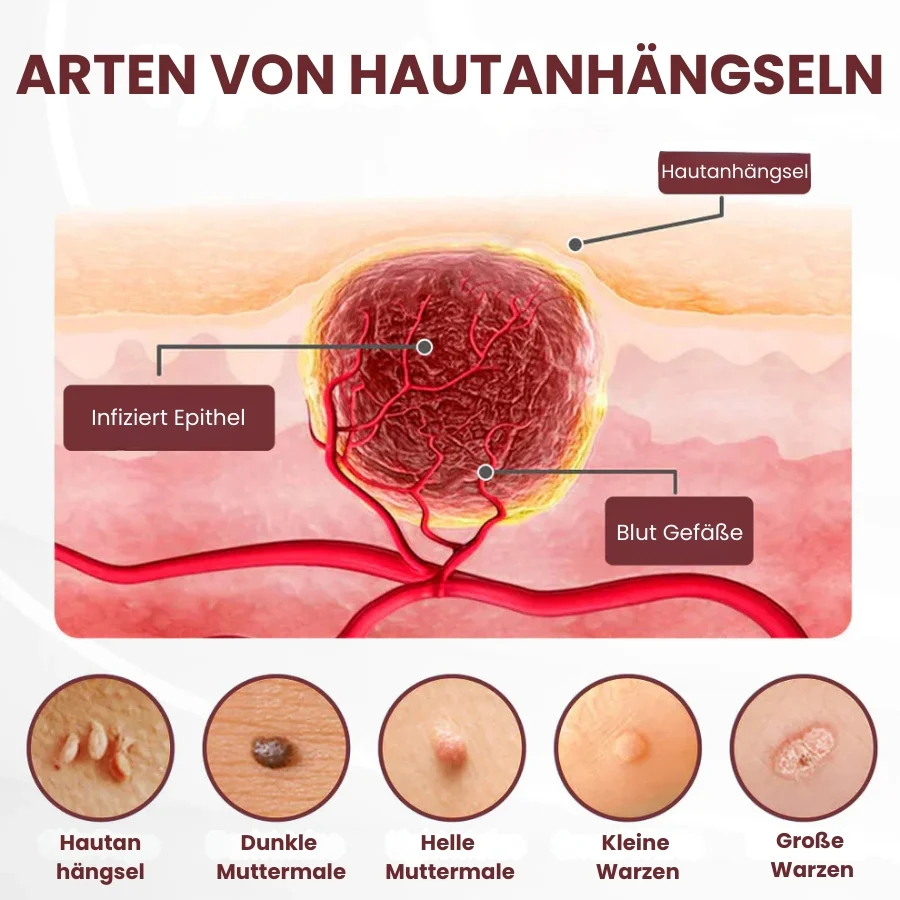 KeraErase™ | Pflanzliche Warzenentfernungscreme mit Doppelwirkung - Image 3