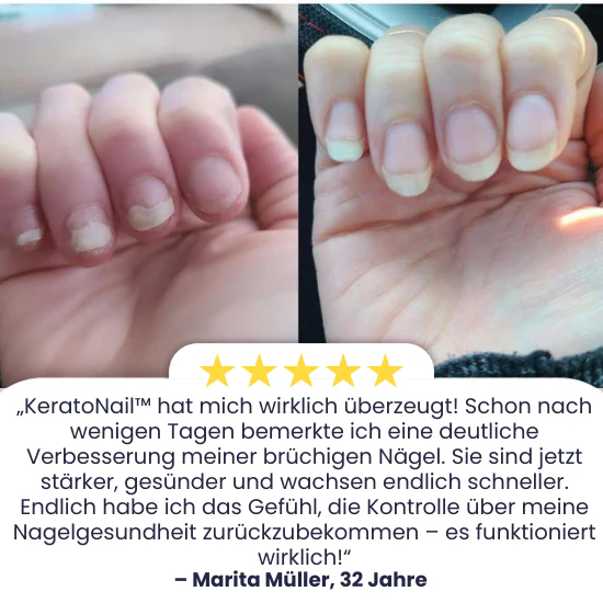 KeratoNaill™ | Verwandeln Sie schwache Nägel! - Image 3