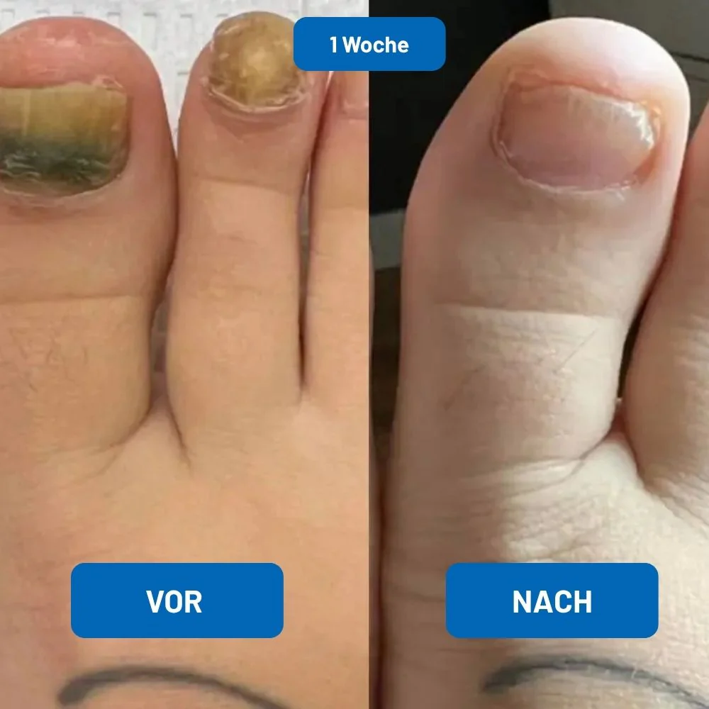 LaserKlar™ | Medizinischer Nagelpilz-Laser - Image 3