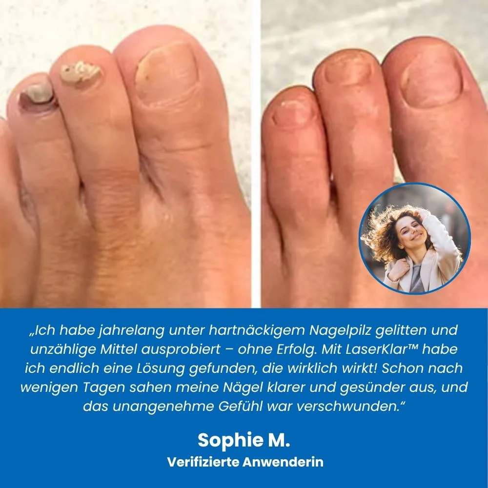 LaserKlar™ | Medizinischer Nagelpilz-Laser - Image 5