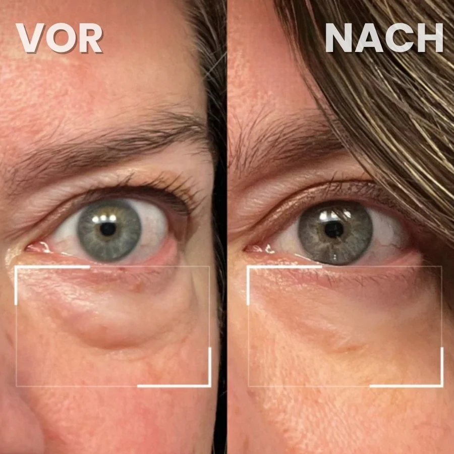 LidLift™ | Augenlid-Straffungscreme - Image 5