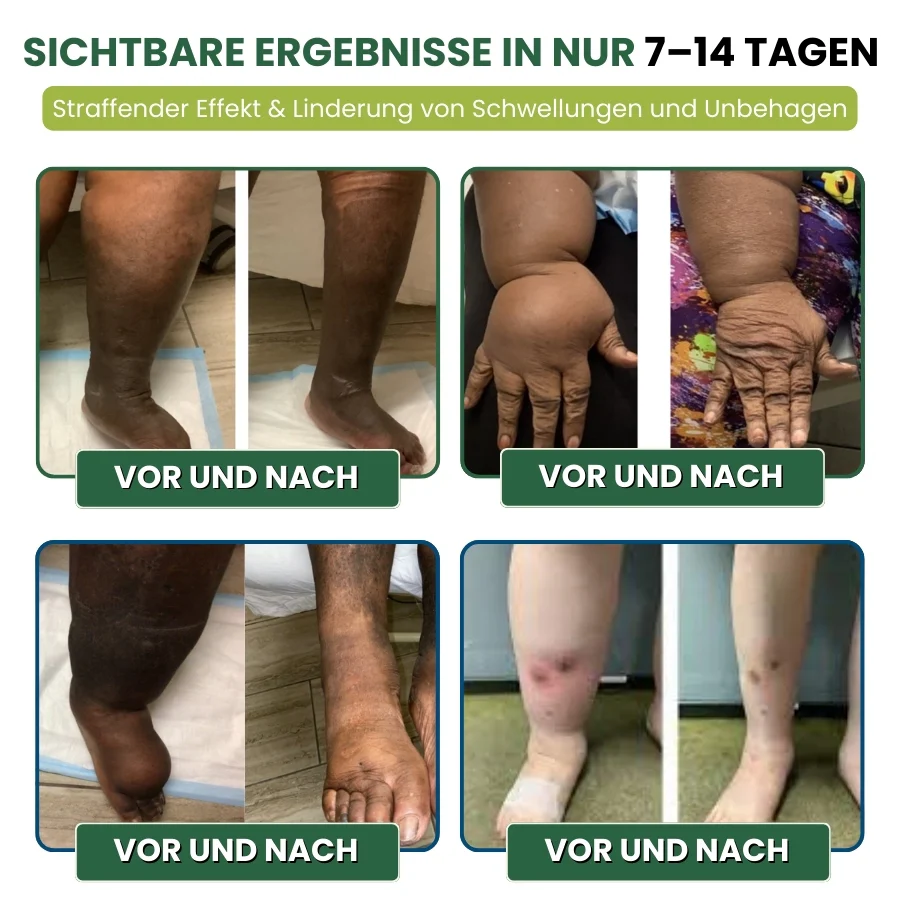 MiracleBalm™ | Beinschwellungen Linderndes Pflege-Balsam - Image 5