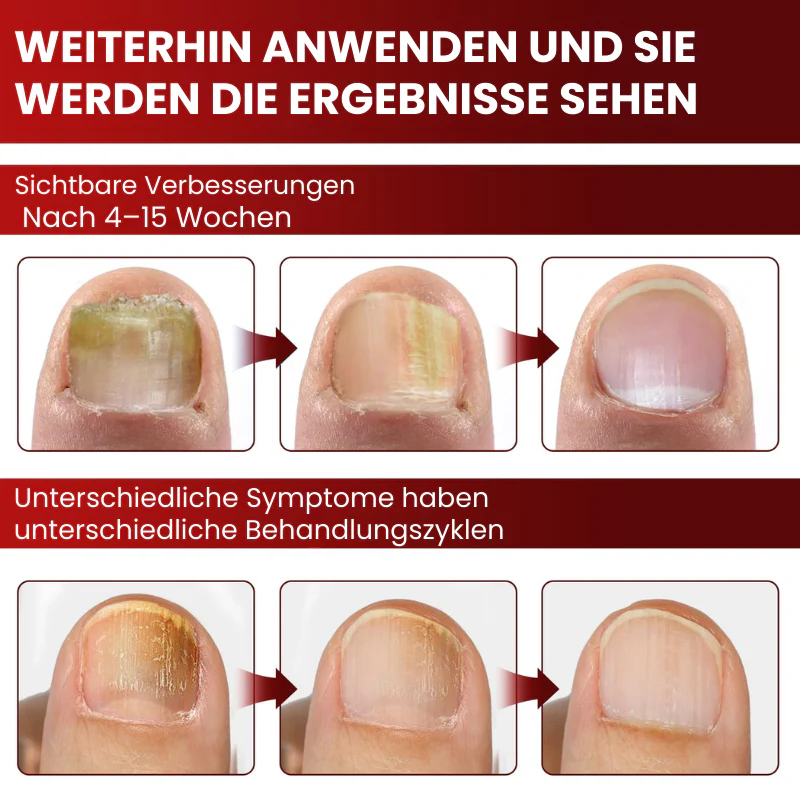 NailGuard™ | Behandlung von Fußnagelpilz - Image 7