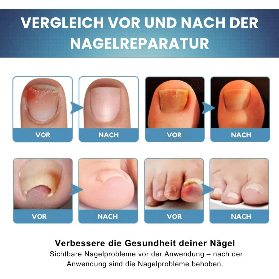 Nailixir™ | Nagelpilzbehandlungssalbe - Image 3