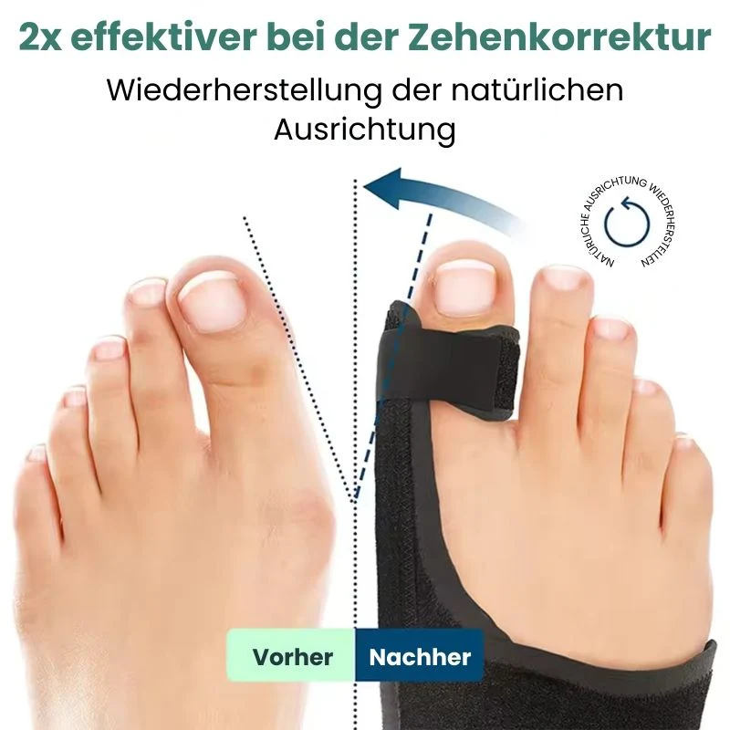 OrthoAlign™ | Sichtbare Korrektur bei Hallux Valgus bereits ab der ersten Anwendung! - Image 8