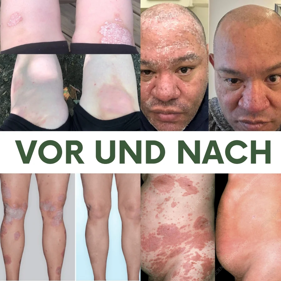 PsoriaCalm™ | Ekzem- und Psoriasis-Creme - Image 10