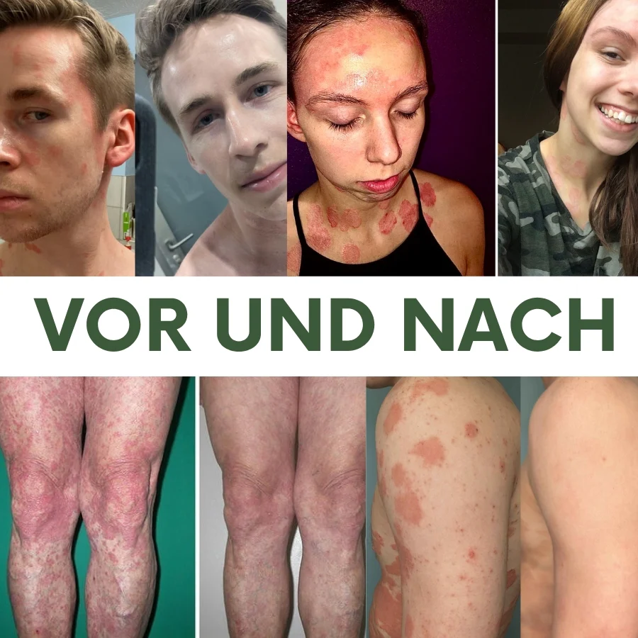 PsoriaCalm™ | Ekzem- und Psoriasis-Creme - Image 11