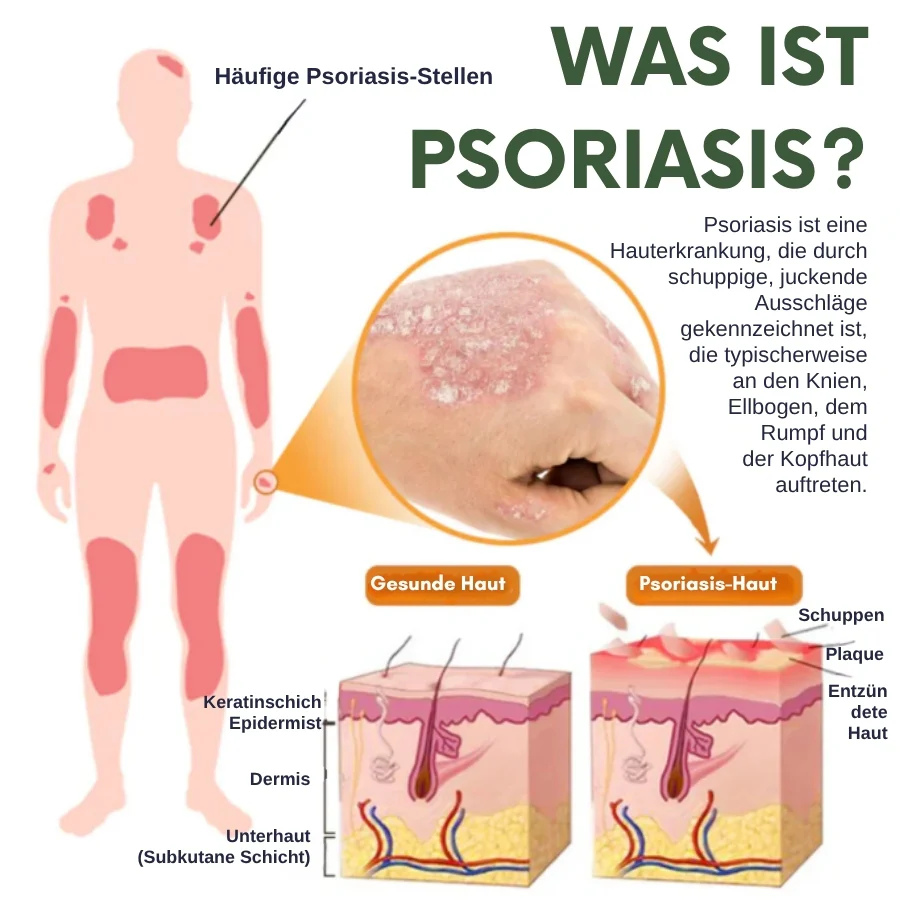 PsoriaCalm™ | Ekzem- und Psoriasis-Creme - Image 2