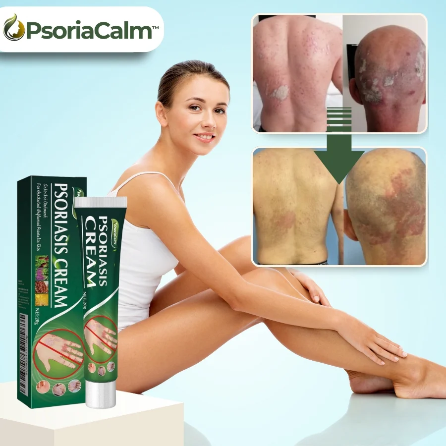 PsoriaCalm™ | Ekzem- und Psoriasis-Creme - Image 5