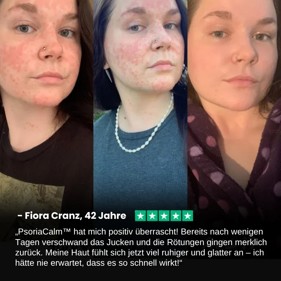 PsoriaCalm™ | Ekzem- und Psoriasis-Creme - Image 6