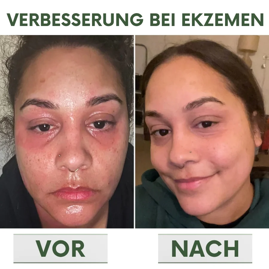 PsoriaCalm™ | Ekzem- und Psoriasis-Creme - Image 8