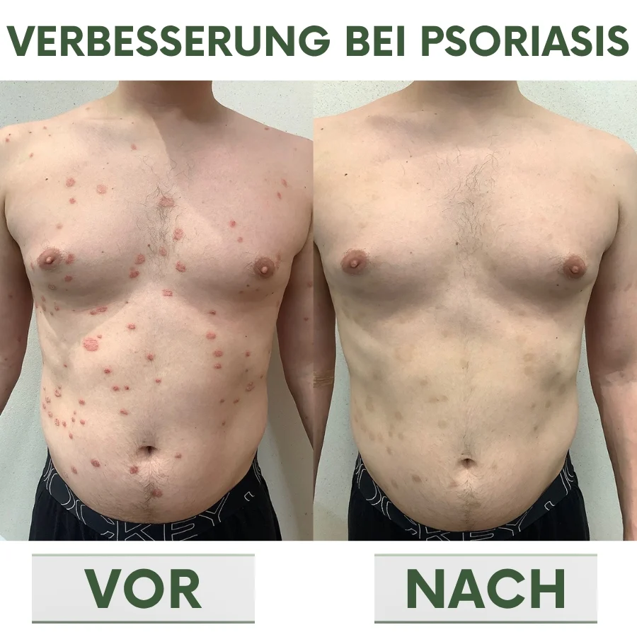 PsoriaCalm™ | Ekzem- und Psoriasis-Creme - Image 9
