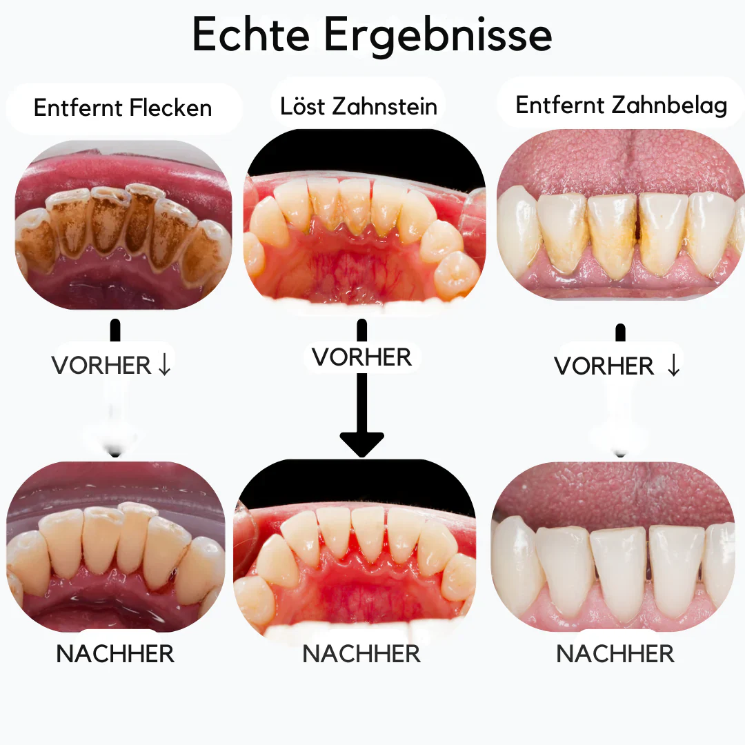 SmiSonic™ | Zahnreiniger - Image 3