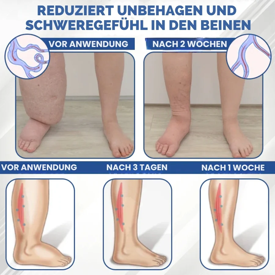 SwelEase™ | Kräutercreme zur Ödempflege - Image 2