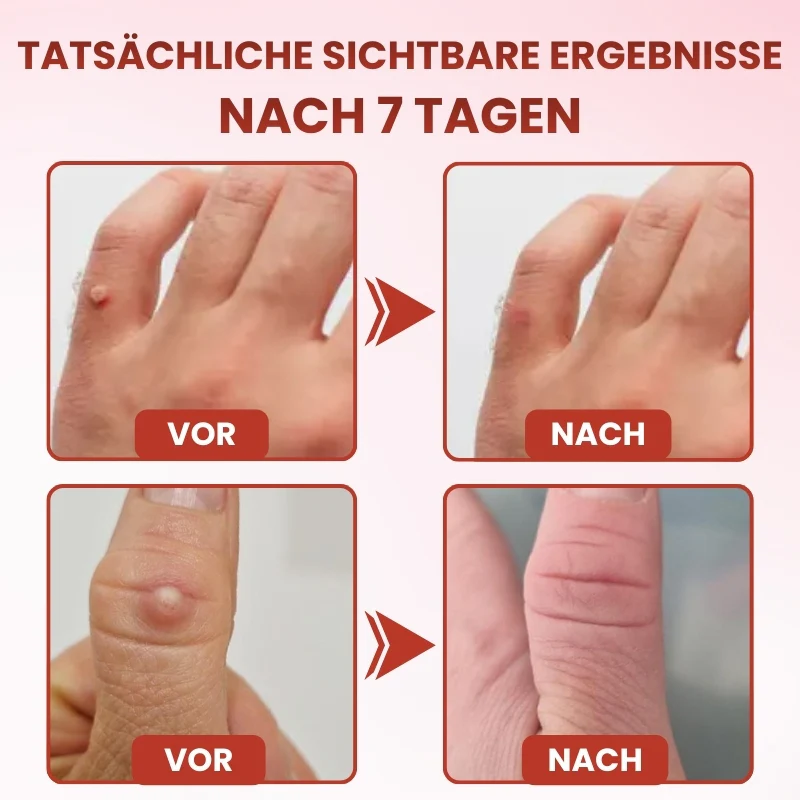 TagGone™ | Schmerzfreie Hautanhängsel-Entfernung mit MicroDart-Pflastern - Image 9