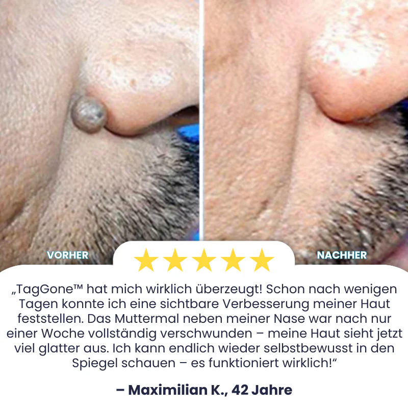 TagGone™ | Tags- und Muttermalentferner - Image 3