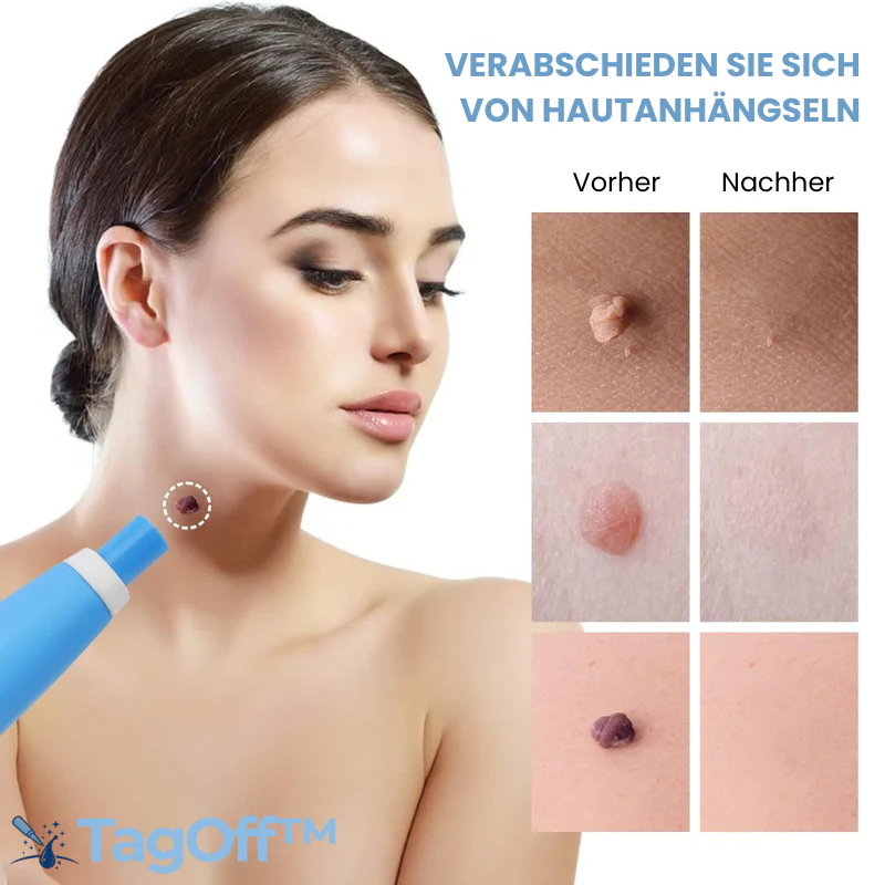 TagOff™ | Komplettset zur Entfernung von Hautanhängseln - Image 7