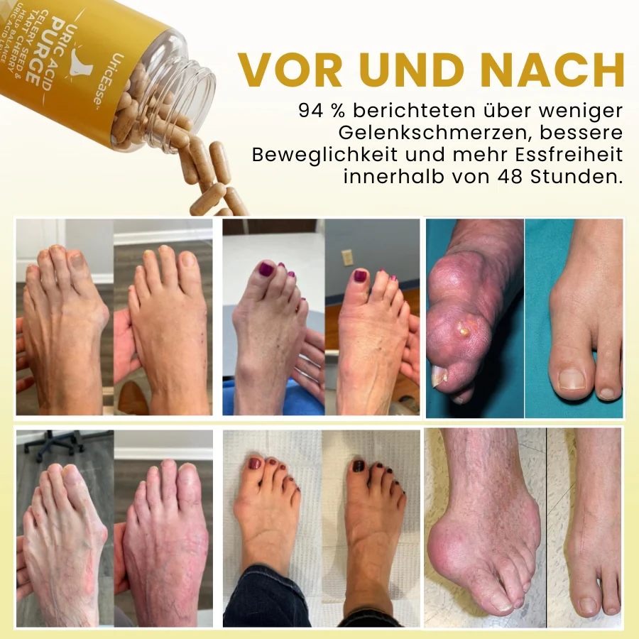 UricEase™ | Formel zum Schutz vor Harnsäure - Image 7