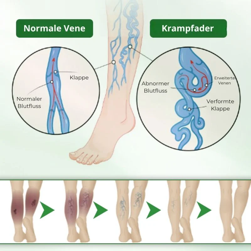 VeinFlex™ | Reduziere Krampfadern um 97 % in nur 2 Wochen! - Image 7