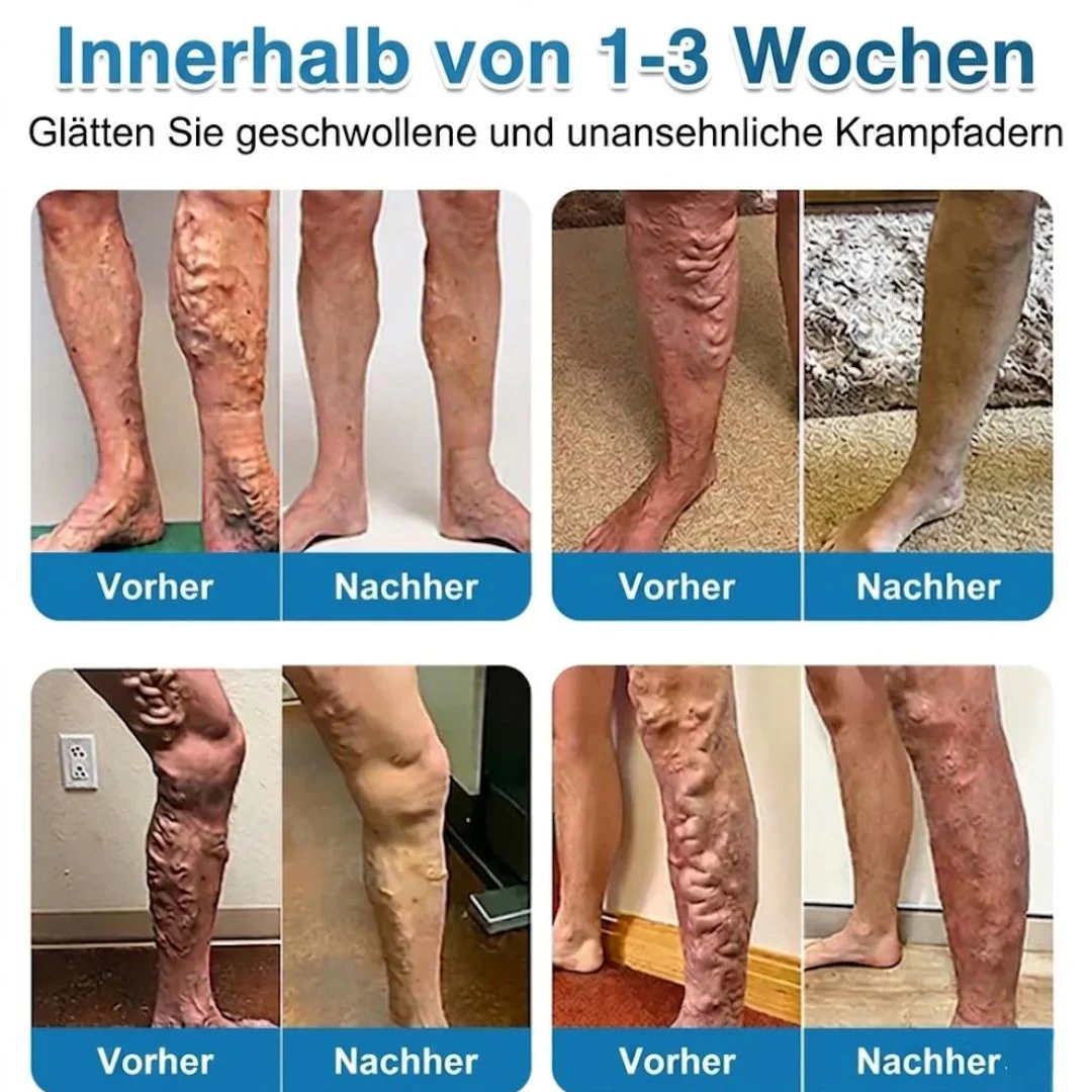 VeinRepair™ | Mikronadel-Pflaster - Image 10