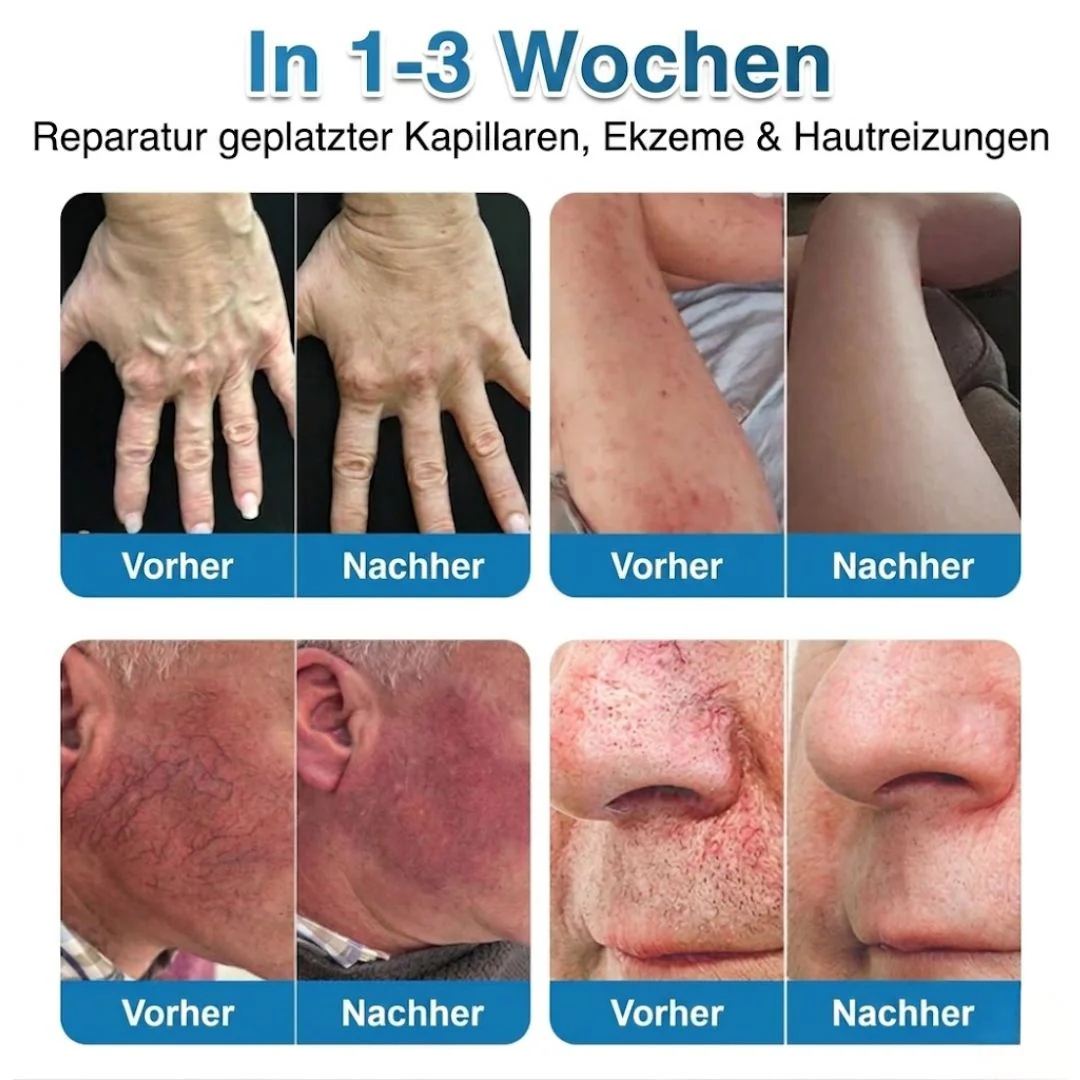 VeinRepair™ | Mikronadel-Pflaster - Image 8