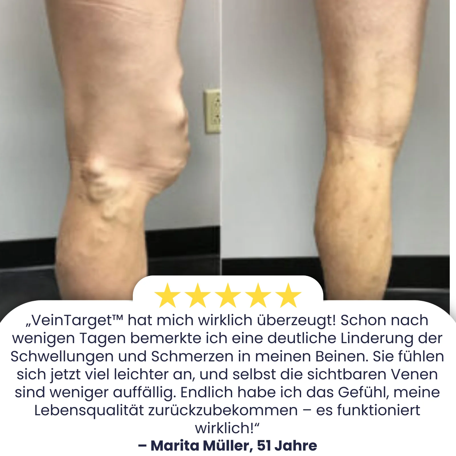 VeinTarget™ | 95 % Linderung – Sichtbare Venenveränderung - Image 3