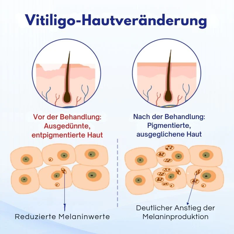 VitiClear™ | Unterstützt 3× schnellere Repigmentierung – sichtbare Ergebnisse in 2 Wochen! - Image 3