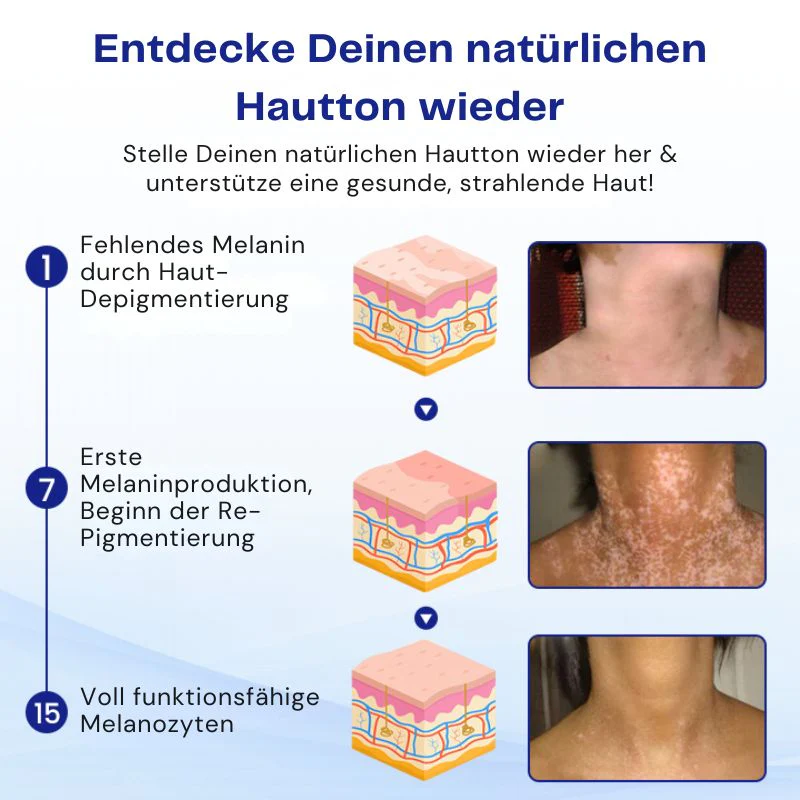 VitiClear™ | Unterstützt 3× schnellere Repigmentierung – sichtbare Ergebnisse in 2 Wochen! - Image 7