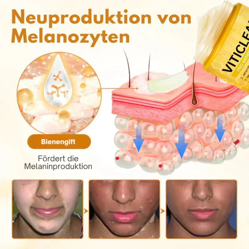 VitiClear™ | Bienengift Vitiligo Creme - Image 3