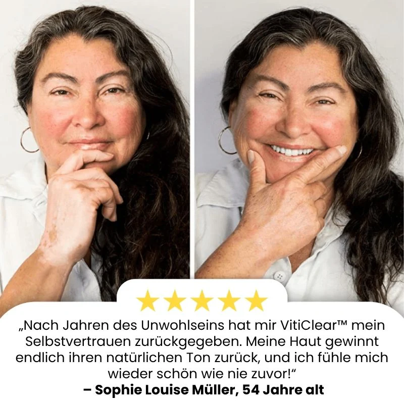 VitiClear™ | Bienengift Vitiligo Creme - Image 8